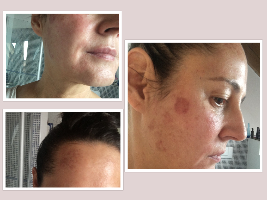 Pigmentflecken entfernen mittels IPL-Laser